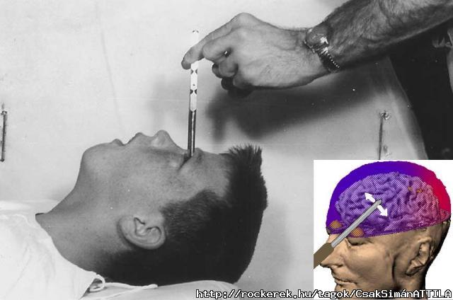 lobotomy....