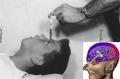 lobotomy....